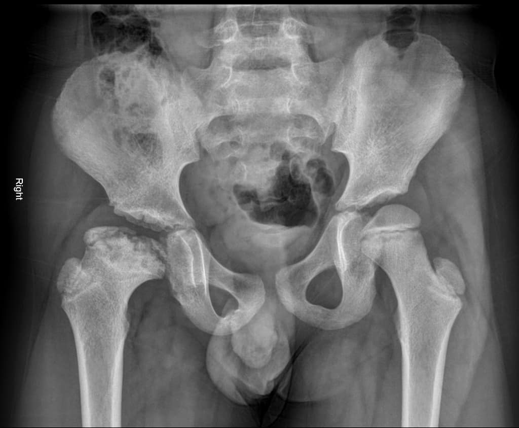 Legg Calve Perthes: लेग काल्व पेर्थेस क्या है? जानें इसके कारण, लक्षण और उपाय