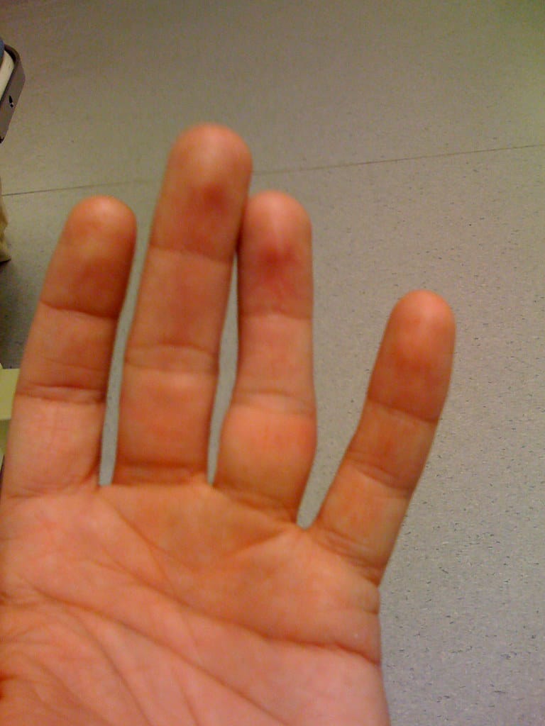 उंगली की हड्डी खिसकना-Dislocated finger