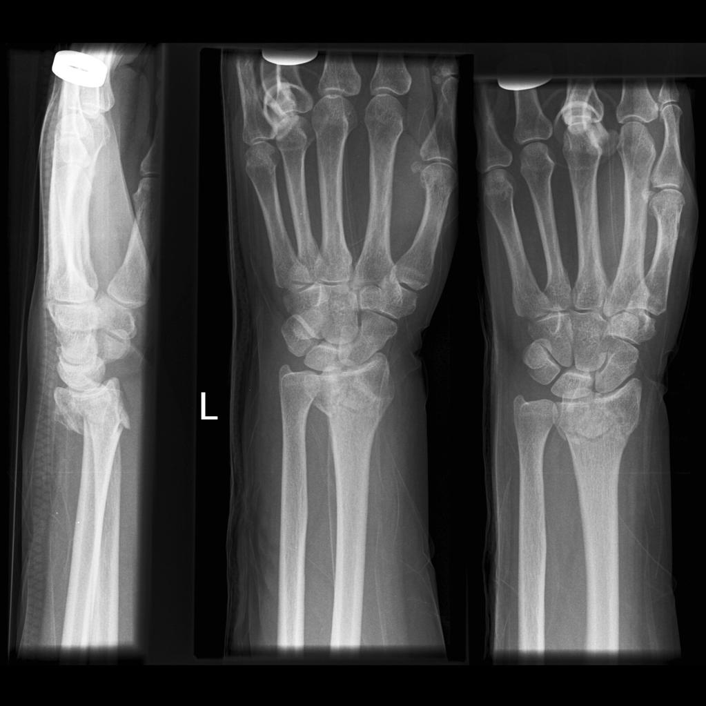 Broken (Colles fractured) wrist : कॉल'स फ्रैक्चर क्या है?