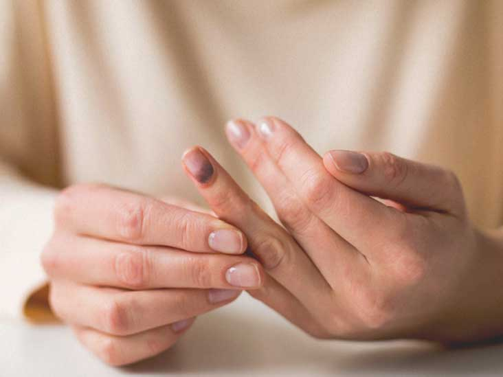 Fingernail Injury: उंगली के नाखून में चोट क्या है? जानें इसके कारण, लक्षण और उपाय