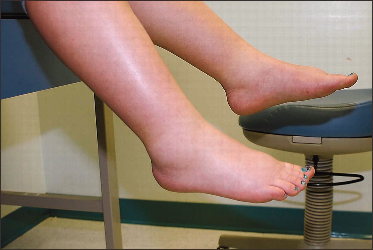 Idiopathic edema: इडियोपैथिक एडिमा क्या है?
