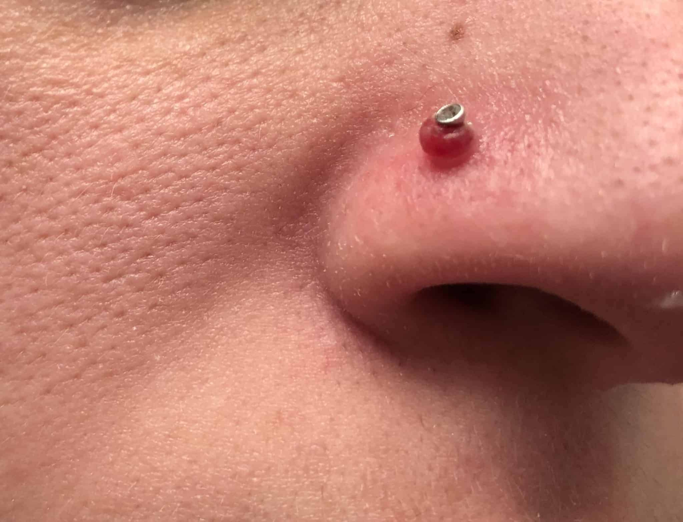 नाक छिदवाने के बाद नोज पियर्सिंग बंप से ऐसे पाएं राहत (Nose piercing bump treatment)