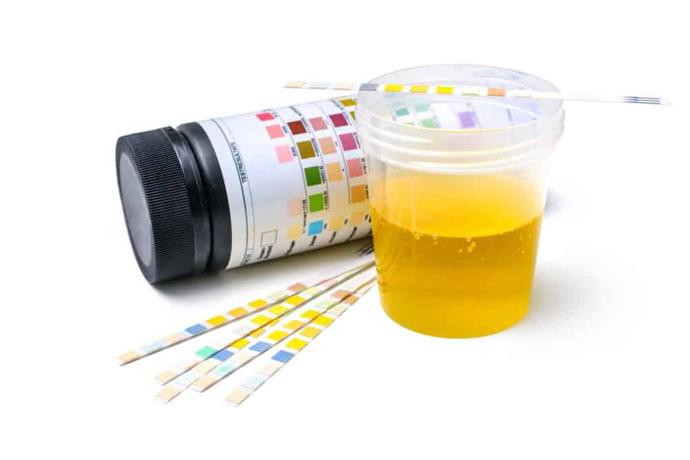 Urinalysis (Urine Test): Why and How is it Done?