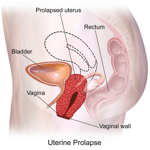Prolapse Bladder: प्रोलैप्स ब्लैडर क्या है?