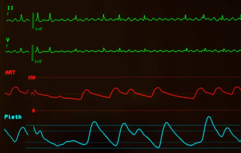 Atrial flutter : एट्रियल फ्लटर क्या है? जानिए इसके कारण, लक्षण और उपाय