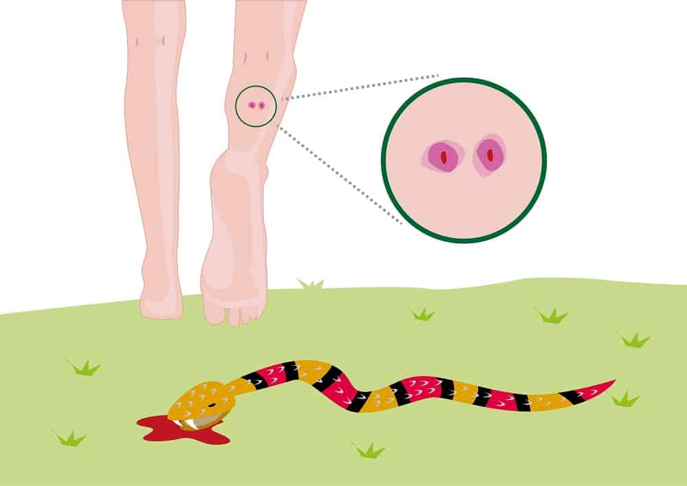 सांप काटने का इलाज कैसे करें? जानिए फर्स्ट ऐड