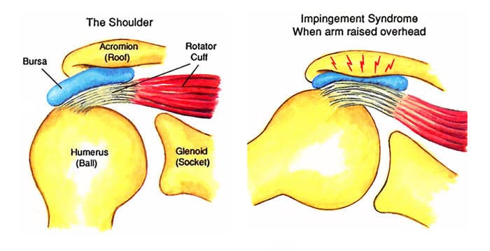 Impingement syndrome: इम्पिन्गेमेंट सिंड्रोम क्या है?