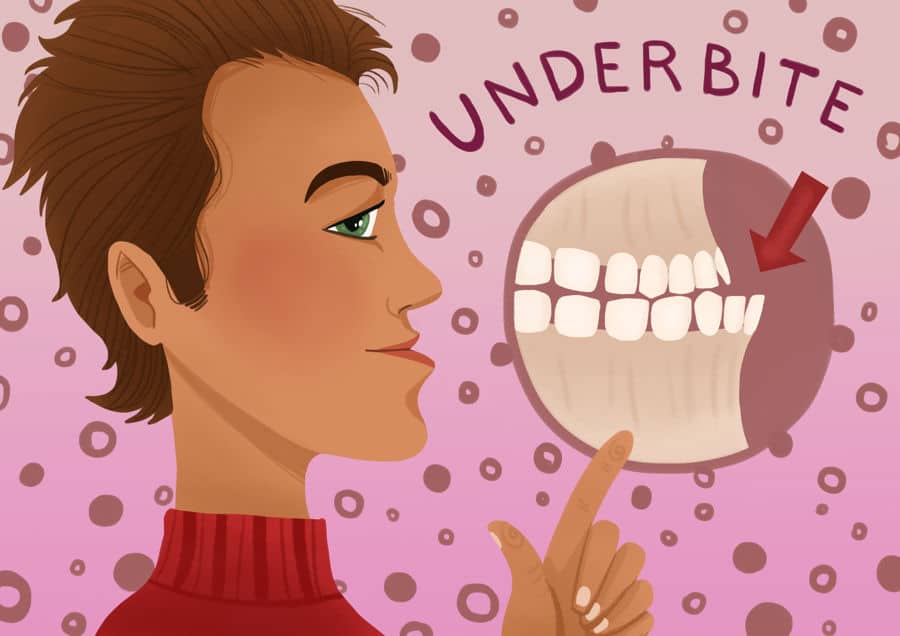 Malocclusion: मैलोक्लूजन क्या है? जानिए इसके कारण, लक्षण और उपाय