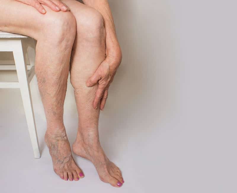 Venous Insufficiency: शिरापरक अपर्याप्तता क्या है?