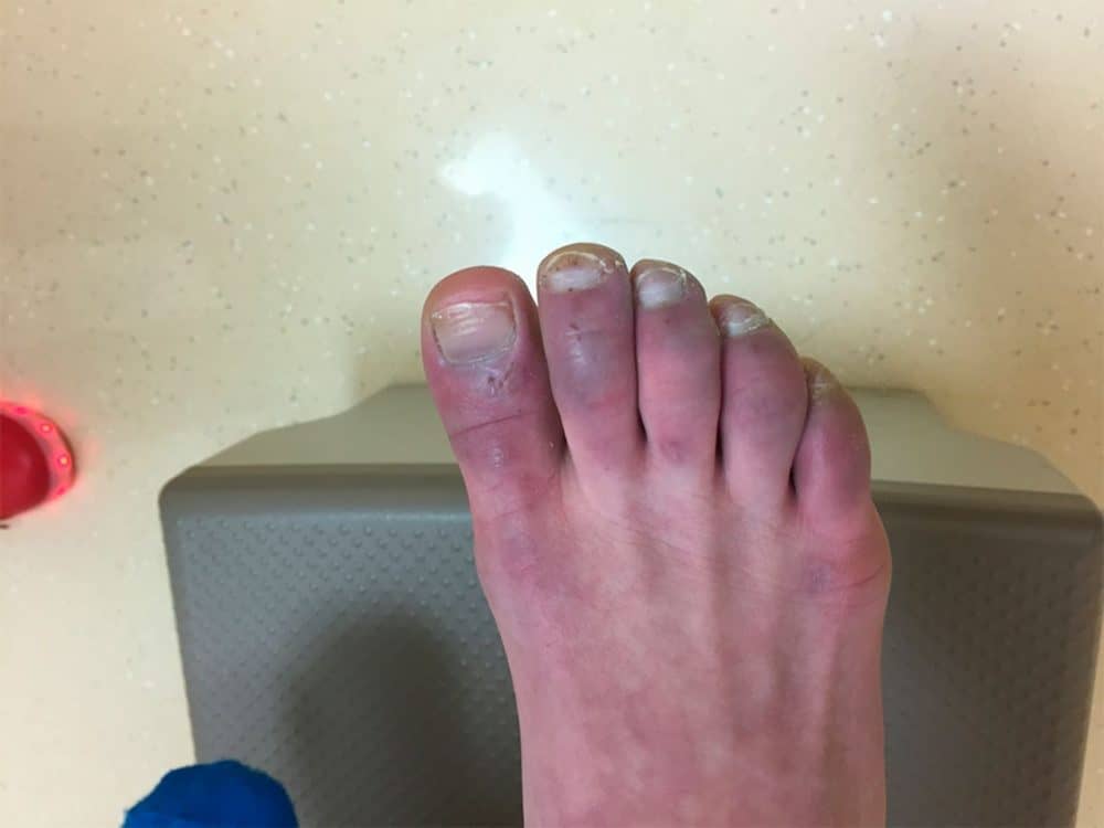 Acrocyanosis: एक्रॉसीनोसिस क्या है?