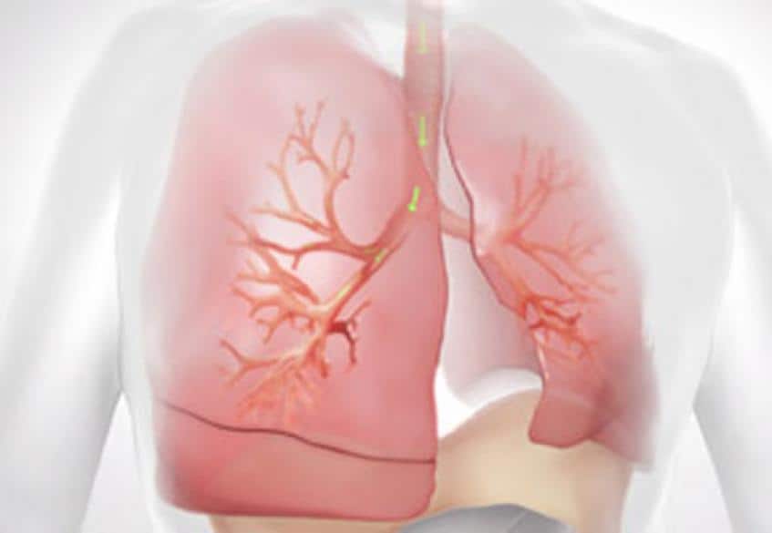 Emphysema: वातस्फीति क्या है?
