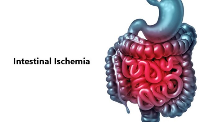 Intestinal Ischemia: जानें इंटेस्टाइनल इस्किमिया क्या है?