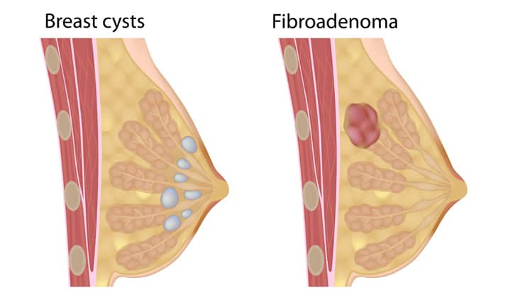 Breast cyst: ब्रेस्ट सिस्ट (स्तन पुटी) क्या है?