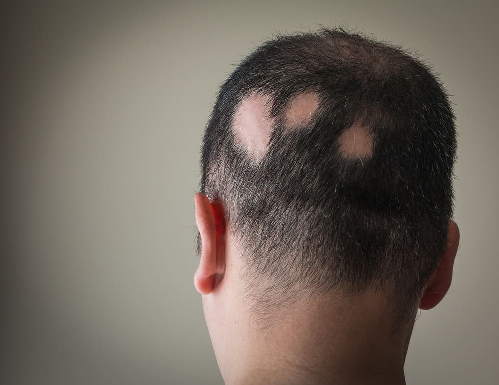 Alopecia Areata: अलोपेसिया अरीटा क्या है?