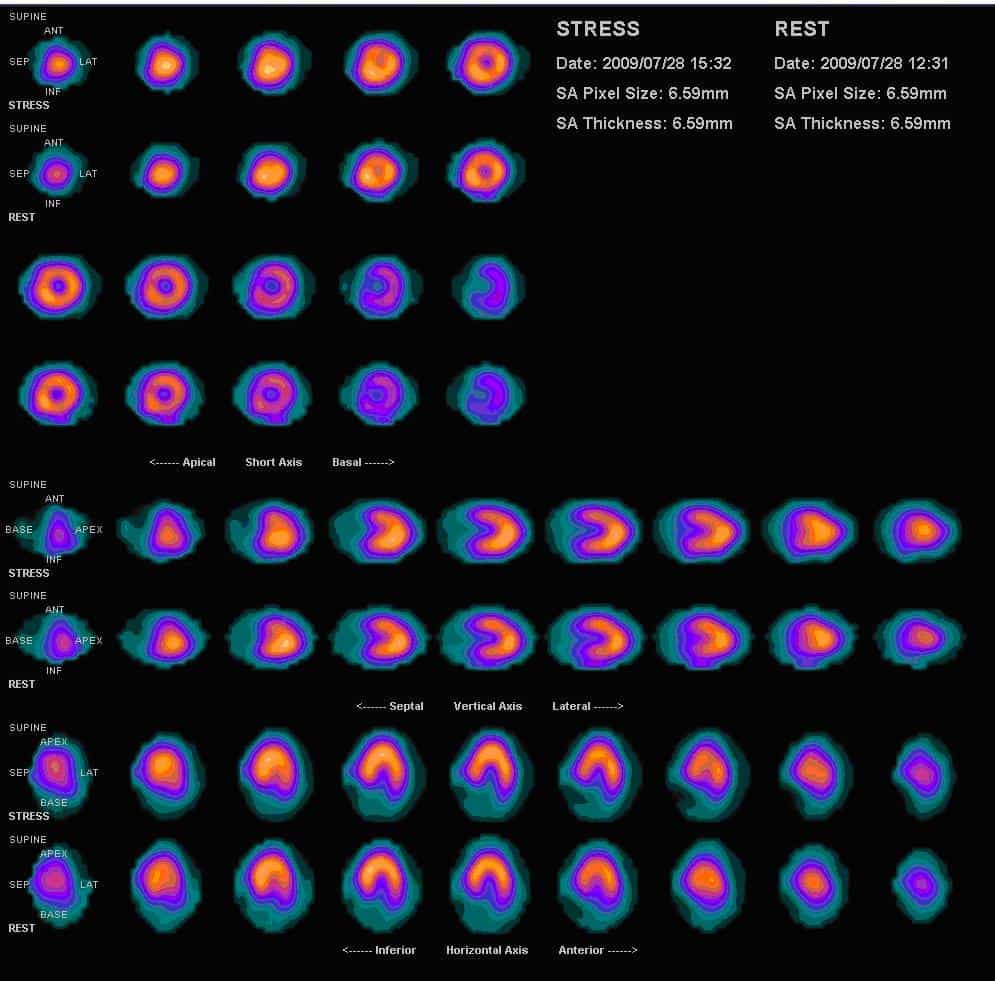 Cardiac perfusion test: कार्डियक परफ्यूजन टेस्ट क्या है?