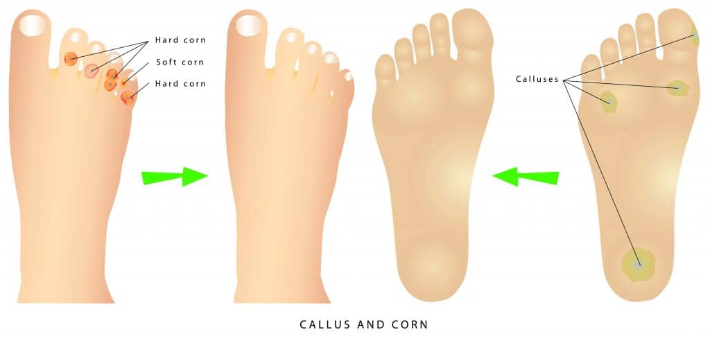 Corns and calluses: कॉर्न्स और कॉलस कैसे स्किन को करते हैं प्रभावित?