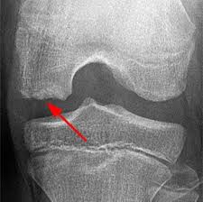 Osteochondritis dissecans: जानिए ऑस्टियोकॉन्ड्राइटिस डिस्केन्स क्या है?