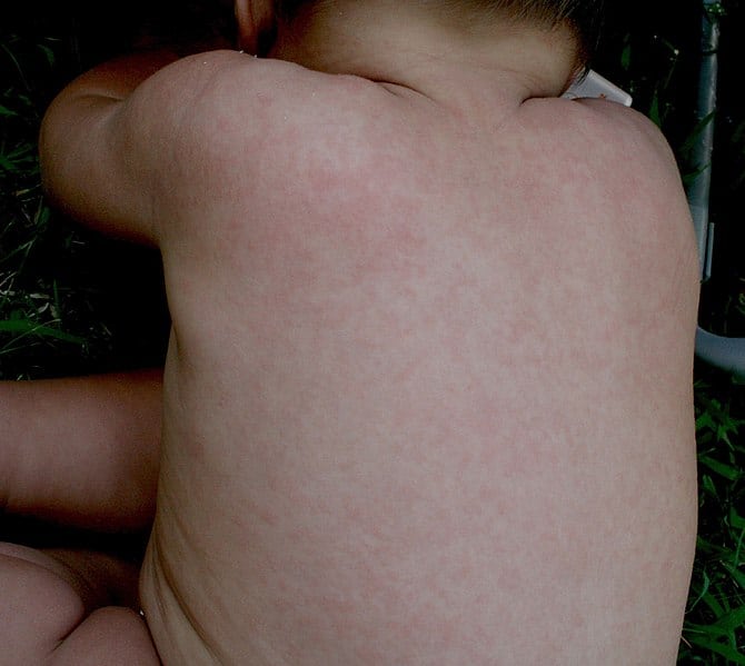 Roseola: रोग रास्योला?