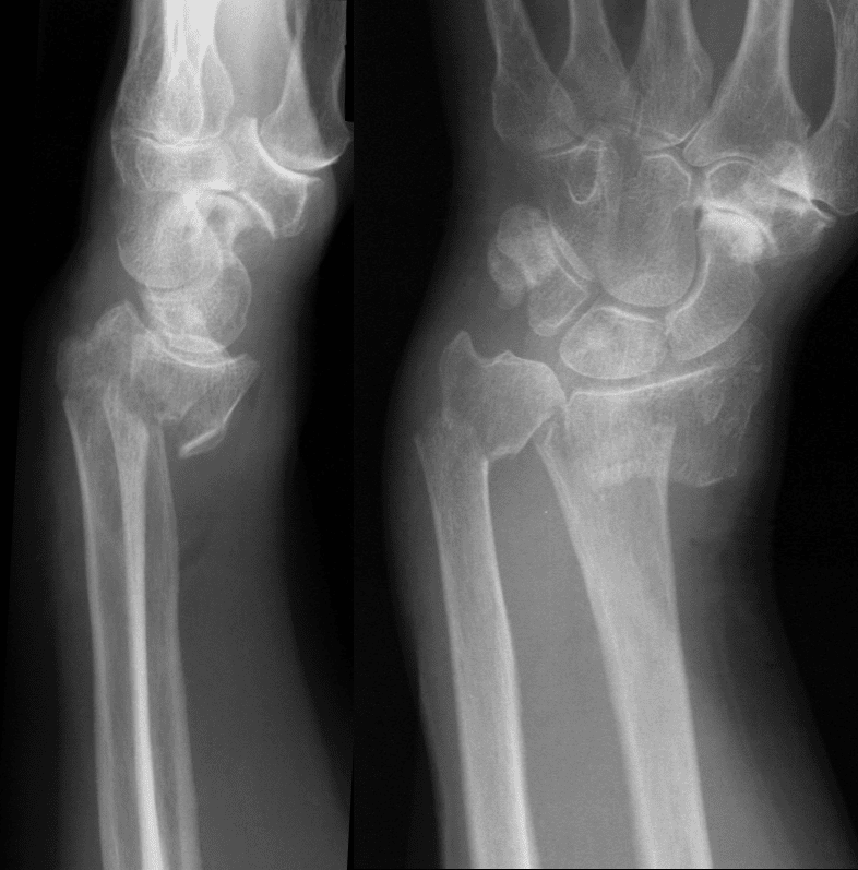 Smith's fracture : स्मिथ फ्रैक्चर क्या है?