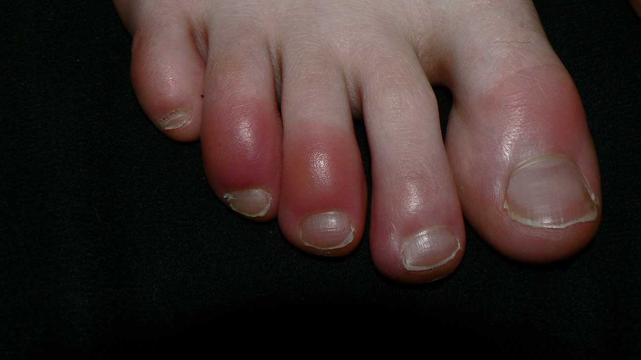 Frostbite : शीतदंश क्या है?