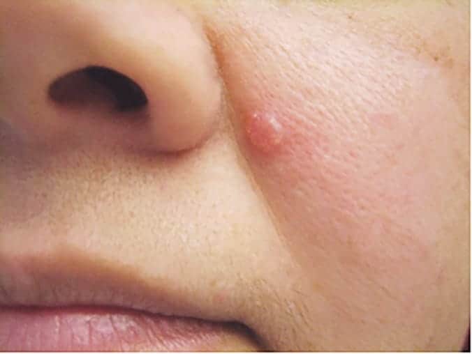 Basal Cell Carcinoma: बेसल सेल कार्सिनोमा क्या है? जानिए इसके कारण, लक्षण और उपाय