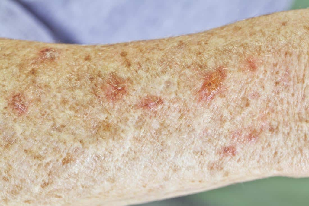 एक्टिनिक केराटोसिस /causes and treatment of actinic keratosis