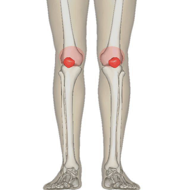 Patellofemoral pain syndrome: पेटेलोफेमोरल पेन सिंड्रोम क्या है?