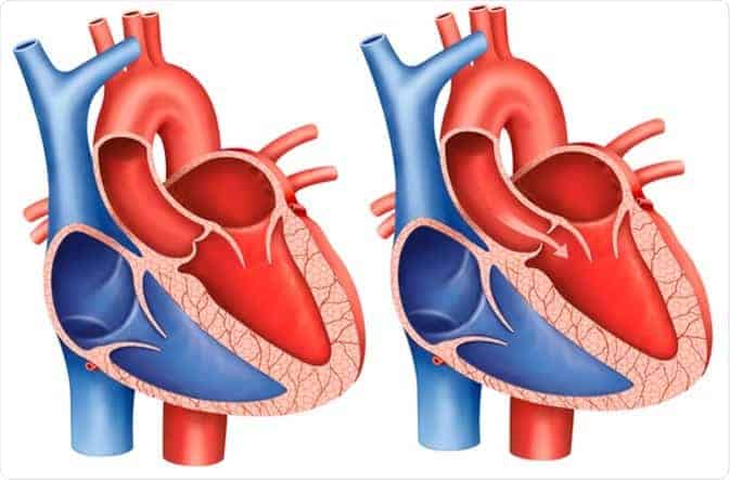 Aortic stenosis: एओर्टिक स्टेनोसिस क्या है?