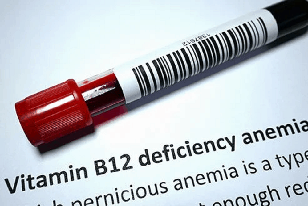 Vitamin B12 Deficiency: विटामिन बी 12 की कमी क्या है?