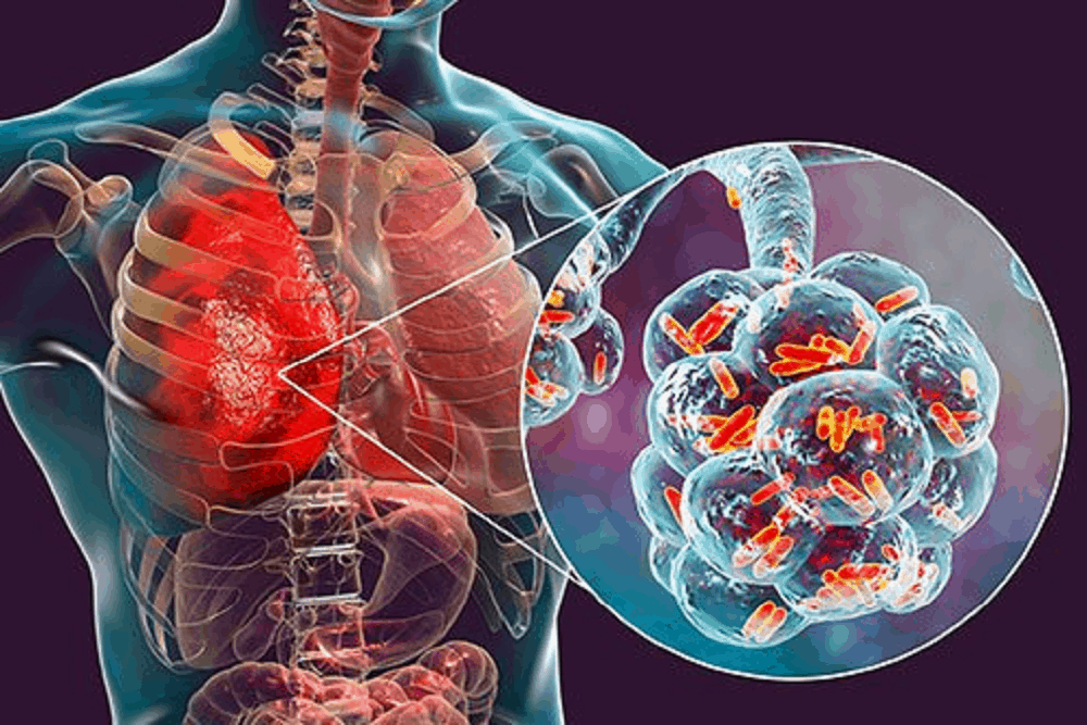 Bacterial pneumonia: बैक्टीरियल निमोनिया क्या है?