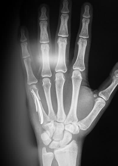 Broken (Boxer's fracture) hand: बॉक्सर'स फ्रैक्चर क्या है?