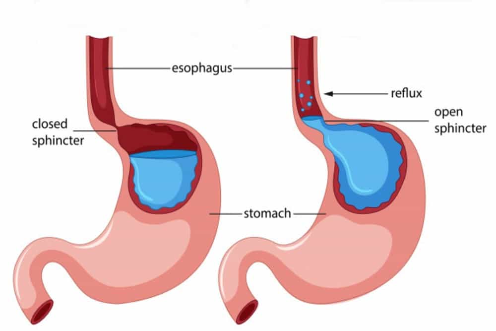 Esophageal spasms: एसोफैगल ऐंठन क्या है?