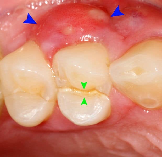 Dental Abscess: डेंटल एब्सेस (दांत का फोड़ा) क्या है?