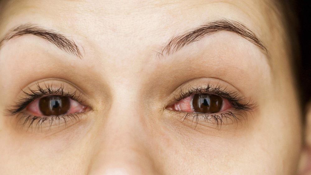 Eye allergies: आंख में एलर्जी क्या है?