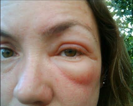 एनाफिलैक्टिक शॉक या सीवर एलर्जिक रिएक्शन क्या है, जानें इसके कारण, लक्षण और इलाज