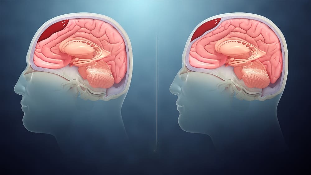 Intracranial Hematoma: इंट्राक्रेनियल हेमाटोमा क्या है?