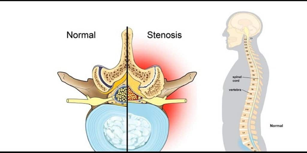Lumbar spinal stenosis: लम्बर स्पाइनल स्टेनोसिस क्या है?