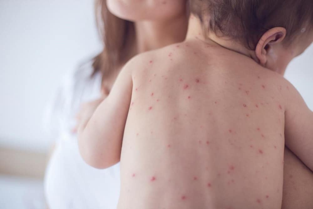 Measles: खसरा क्या है? जानिए इसके कारण, लक्षण और उपाय