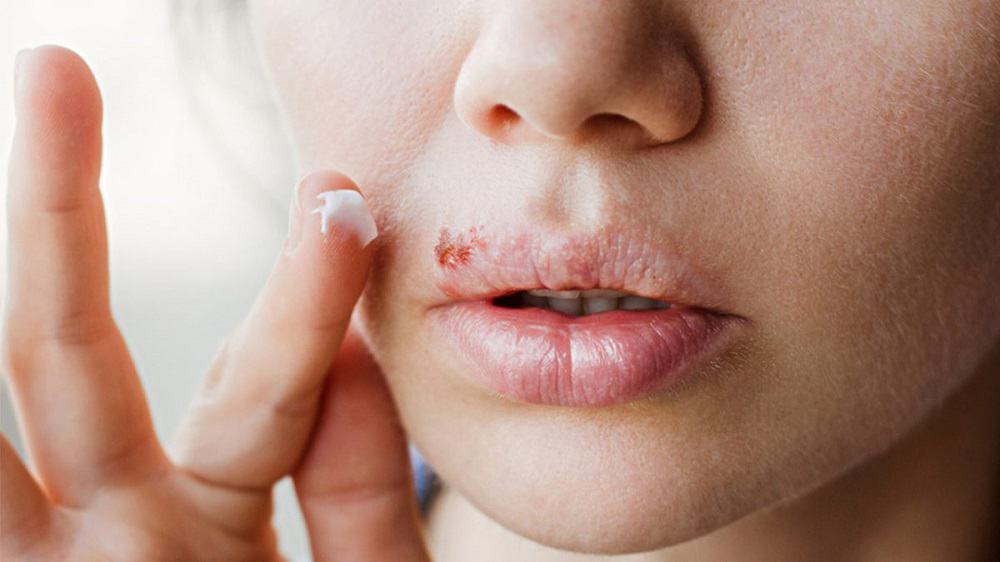 Oral Herpes: ओरल हर्पीस क्या है?