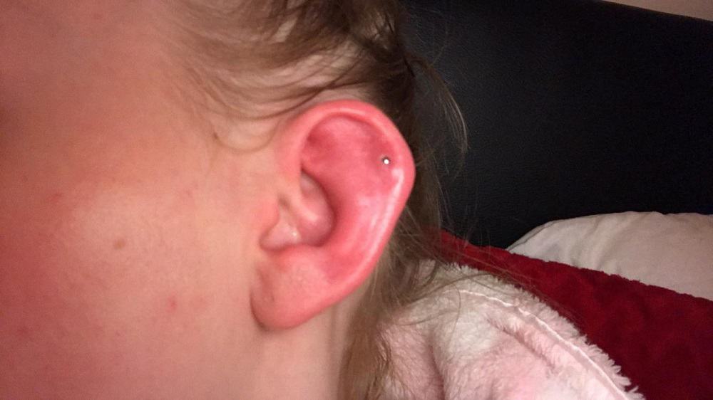 Perichondritis: पेरीकोनड्राइटिस क्या है?