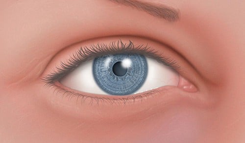 Normal-tension glaucoma: नॉर्मल टेंशन ग्लॉकोमा क्या है?