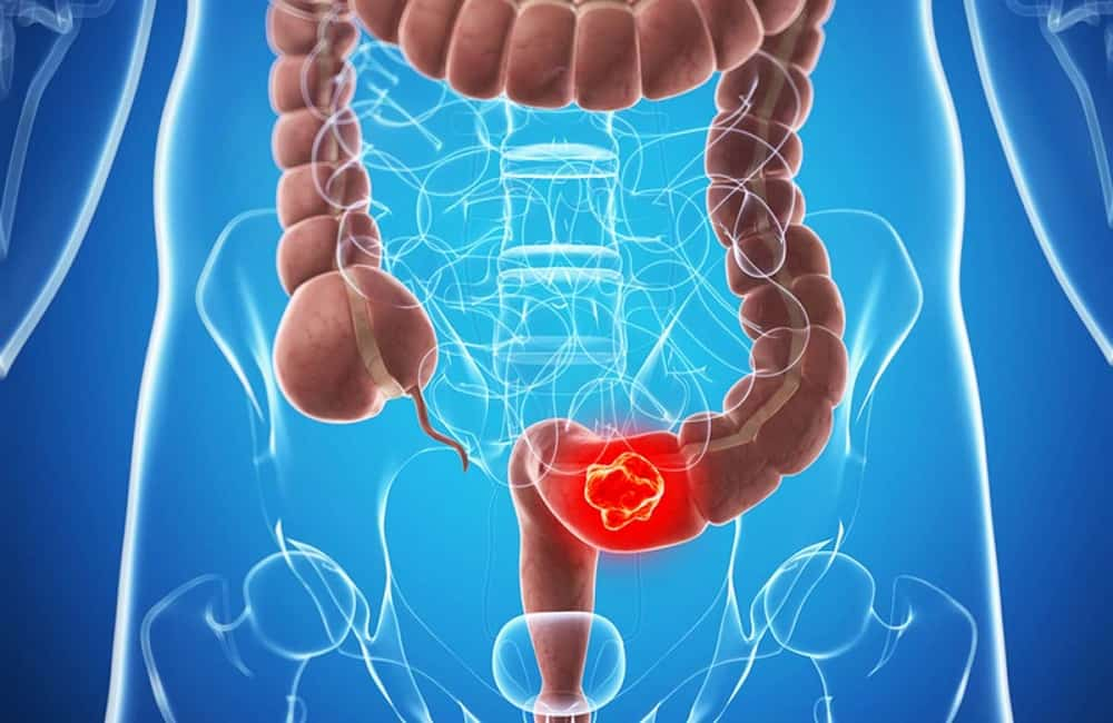 Rectal Cancer: रेक्टल कैंसर क्या है? जानें इसके कारण, लक्षण और उपचार