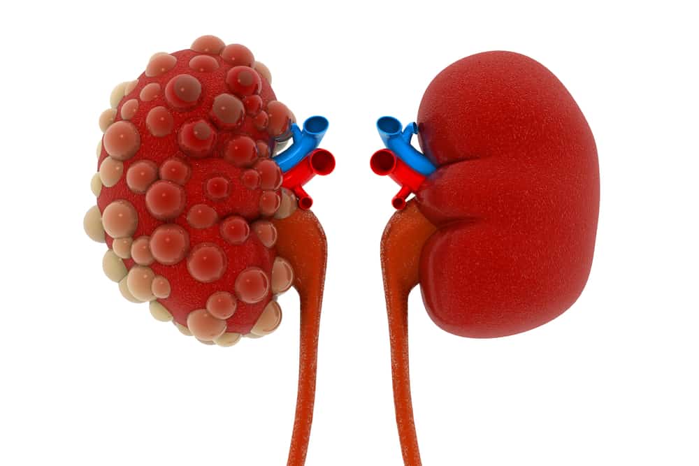 Polycystic kidney disease: पोलिसिस्टिक किडनी डिजीज क्या है?