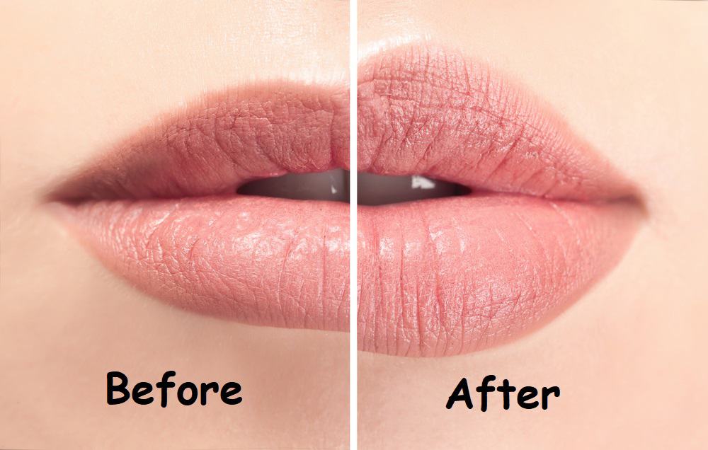 होंठों को आकर्षक बनाने के लिए करवाई जाती है लिप कॉस्मेटिक सर्जरी, जानें इसके फायदे और नुकसान
