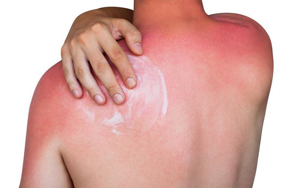 Sunburn: सनबर्न क्या है? जानें इसके कारण, लक्षण और उपाय