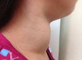 Thyroid storm: थायरॉयड स्टॉर्म क्या है?