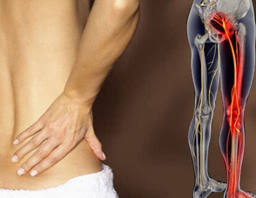 Sciatica: साइटिका क्या है? जानें कारण लक्षण और उपाय