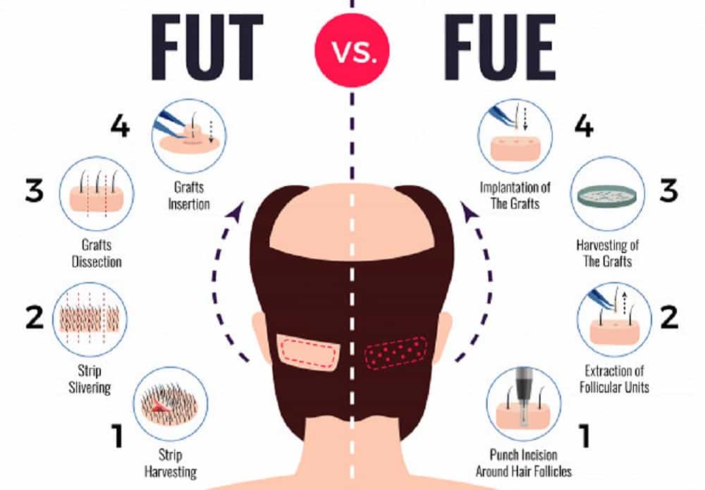 केश ट्रांसप्लांट कितना सफल है? हेयर ट्रांसप्लांट की कीमत के बारे में जानें