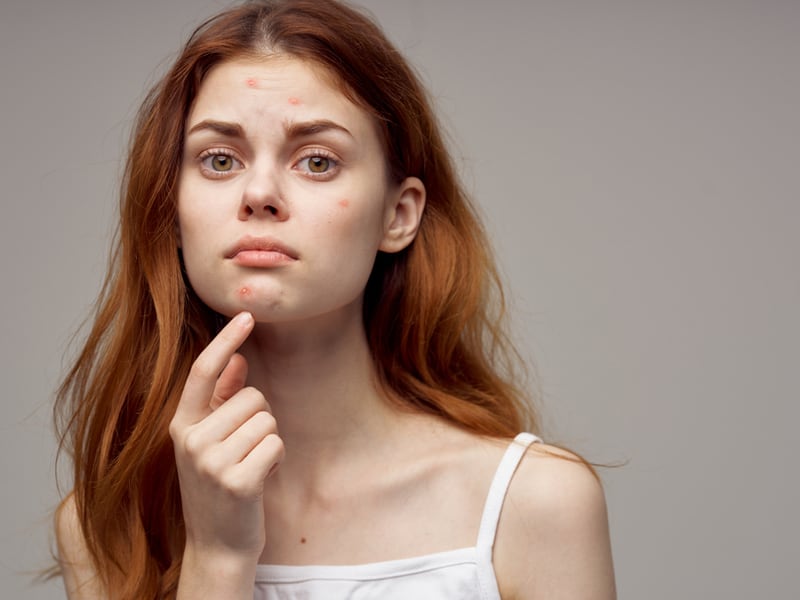 PCOS और एक्ने! 🤔  क्या है दोनों से छुटकारा पाने का रास्ता?