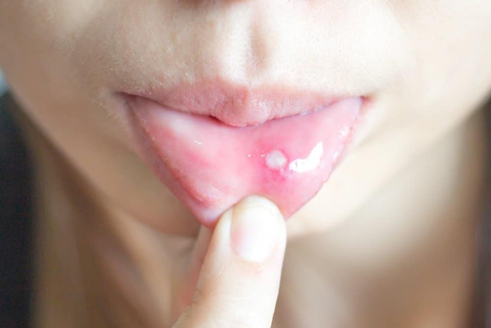 Canker sores: नासूर क्या है?